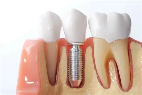 Broken Tooth Management