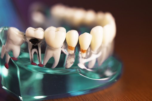 Removable Prosthesis