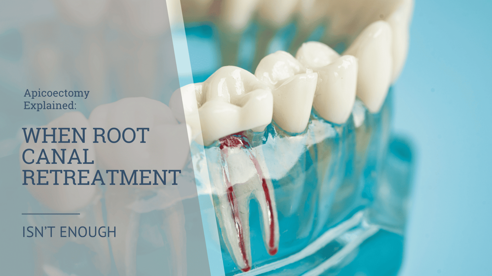 Endodontic Surgery