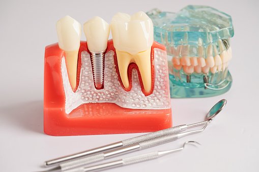 BPS Denture