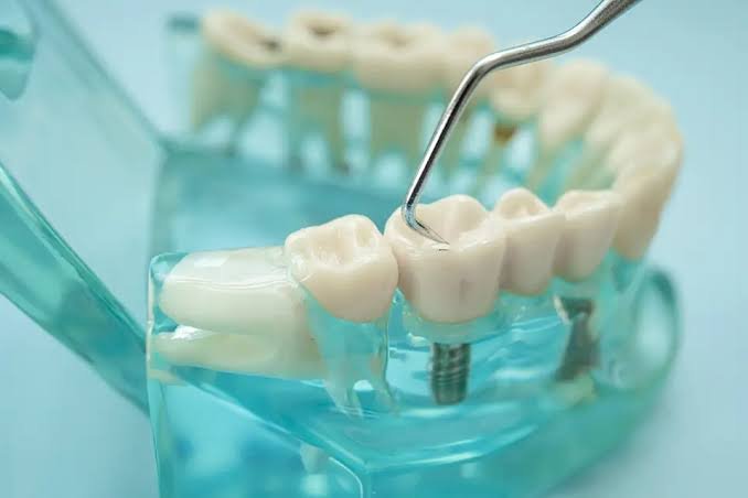 Dental Implants